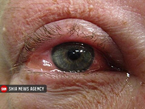 با التهاب چشم ناشی از حساسیت چه کنیم‌؟