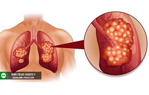 علائم سرطان ریه چیست؟