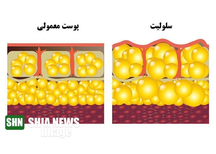 سلولیت چیست؟ | بهترین روش‌های درمان سلولیت در خانه