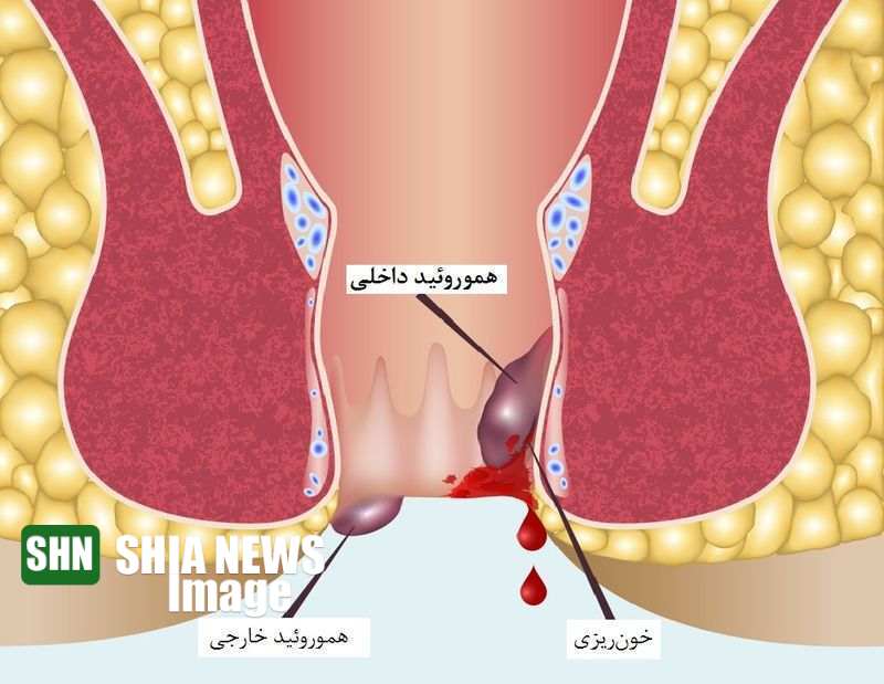 علت ایجاد اختلال دفع مدفوع